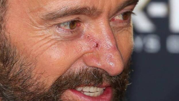 El actor Hugh Jackman, operado por quinta vez de cáncer de piel