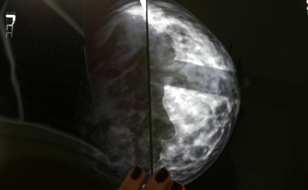 Resultado de una mamografía.  /Reuters
