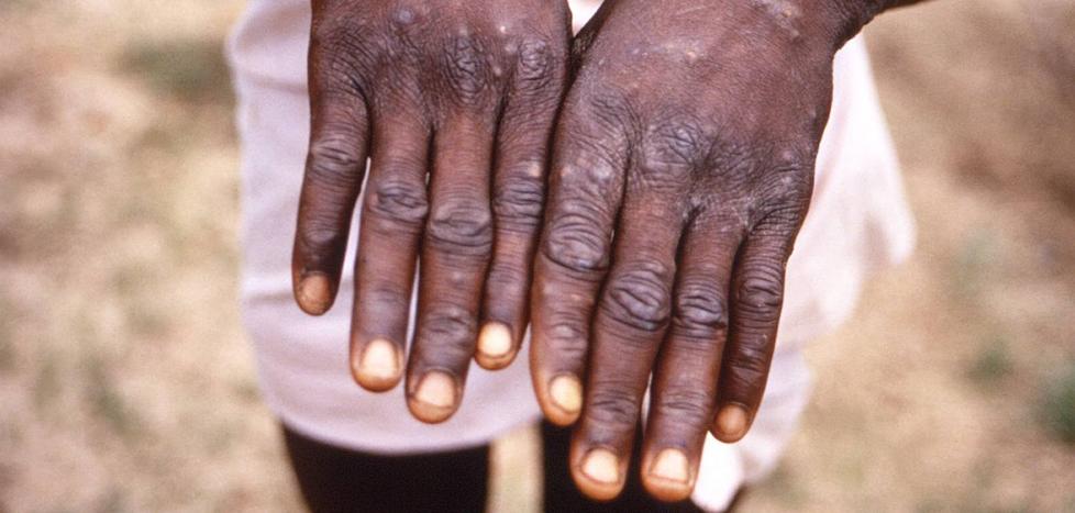 Europe recommends smallpox vaccination for contacts of people infected with monkeypox