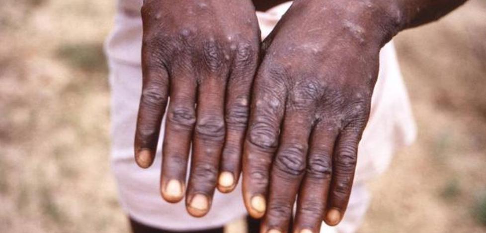 The European Commission buys 109,000 vaccines to combat monkeypox